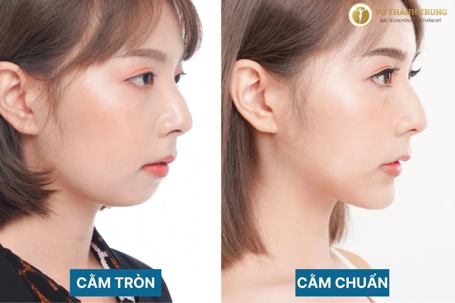 Cằm tròn là như thế nào