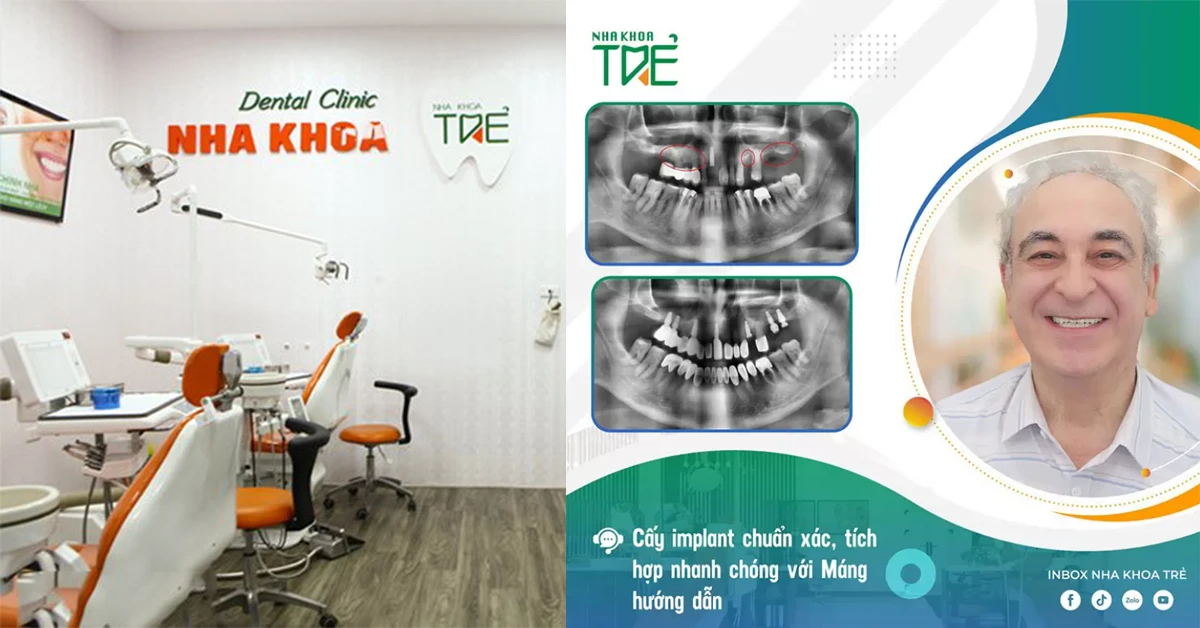 Giá trồng răng implant trọn gói tại 6 nha khoa uy tín Hà Nội