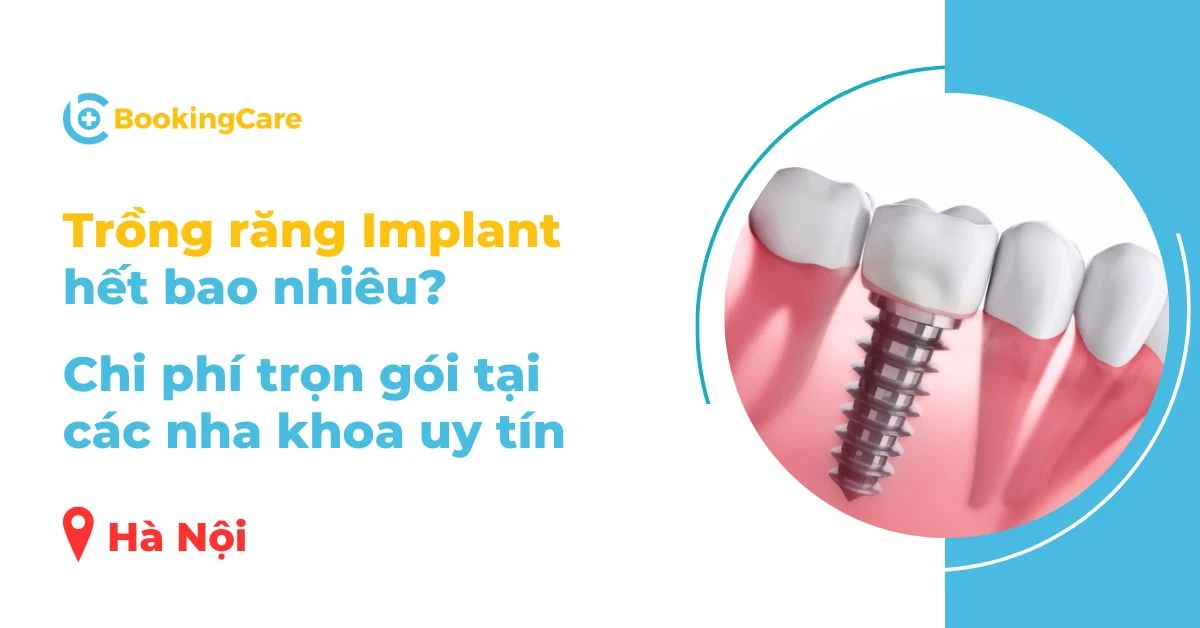 Dịch vụ cấy ghép implant tạo hình hàm răng mới