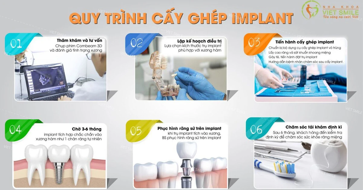 Giá trồng răng implant trọn gói tại 6 nha khoa uy tín Hà Nội