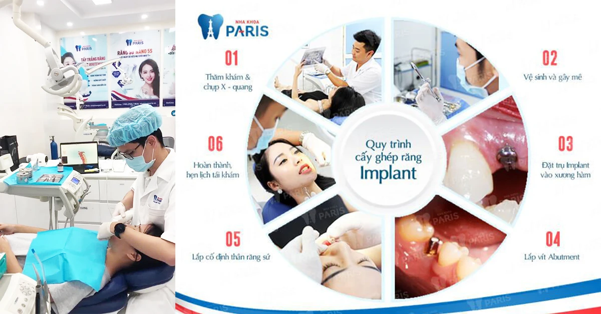 Giá trồng răng implant trọn gói tại 6 nha khoa uy tín Hà Nội